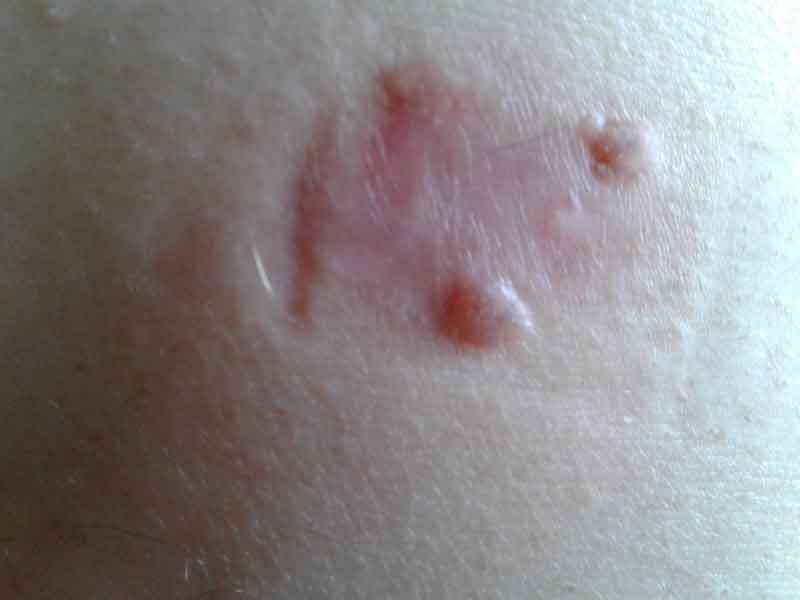unidentified fungal yeast skin infection after treatment