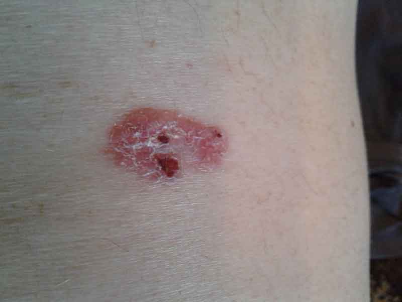 unidentified chronic fungal yeast skin infection before treatment