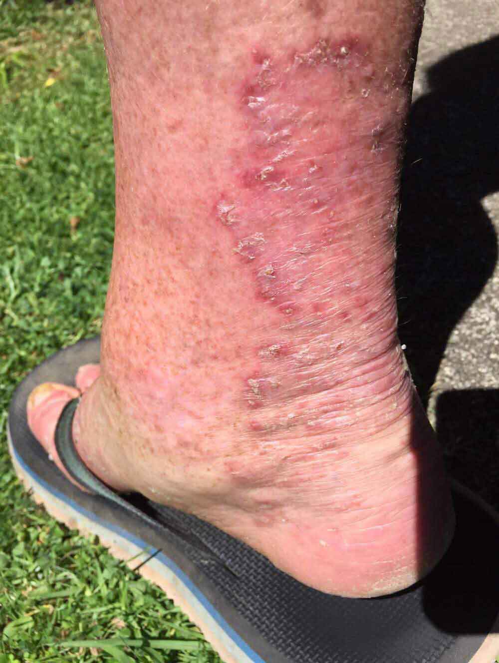 chronic multi drug resistant fungal skin infection of skin on ankle and calf muscle