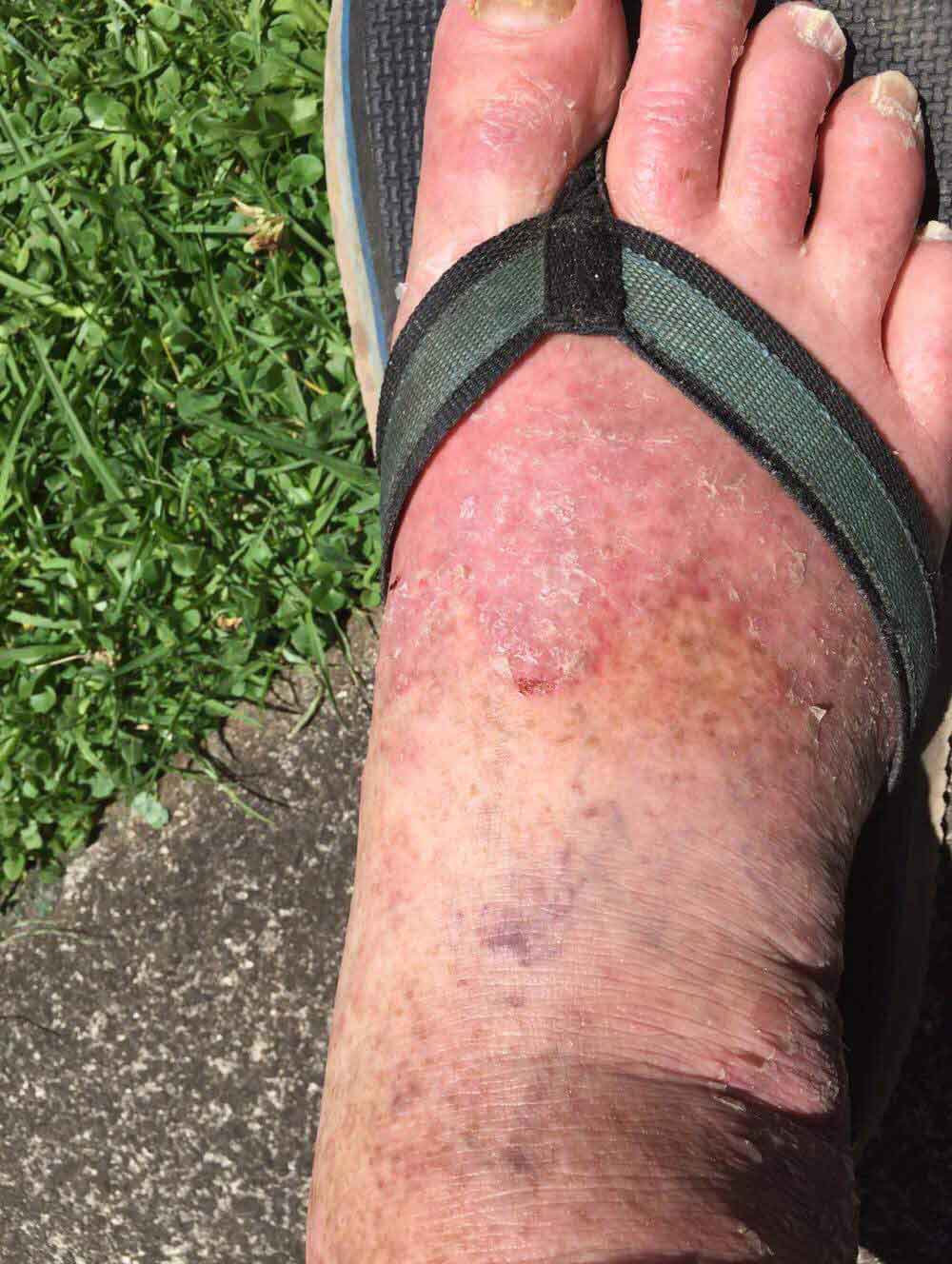 chronic multi drug resistant fungal skin infection top od foot