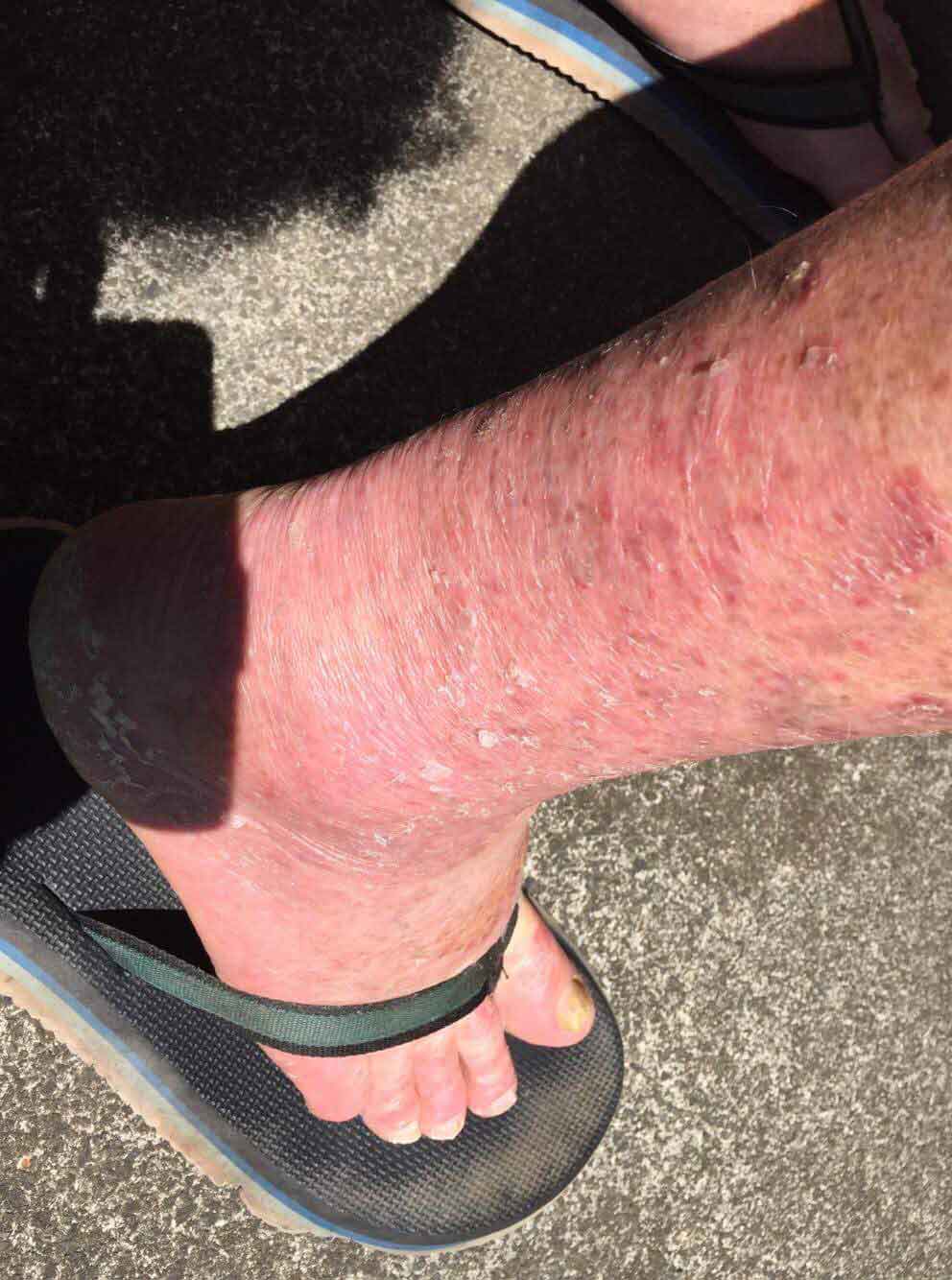chronic multi drug resistant spreading fungal skin infection
