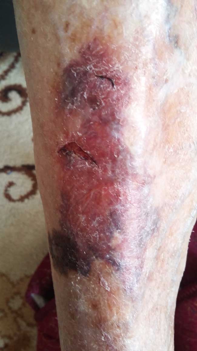 Bruised vitamin c deficient leg