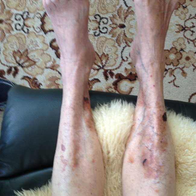 legs treated with vitamin c DHAA serum