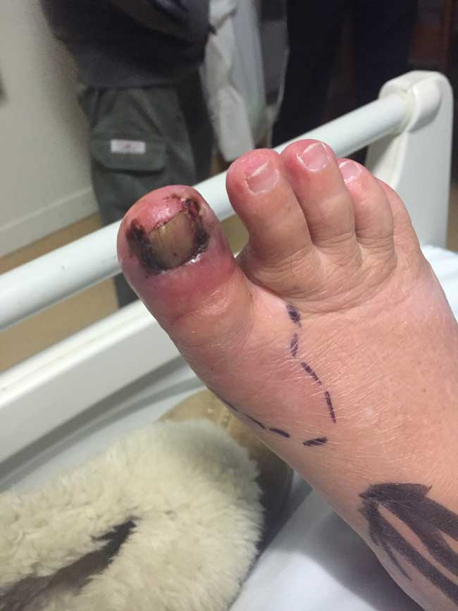 antibiotic resistant Cellulitis