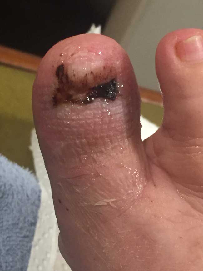 Cellulitis after DHAA serum treatment