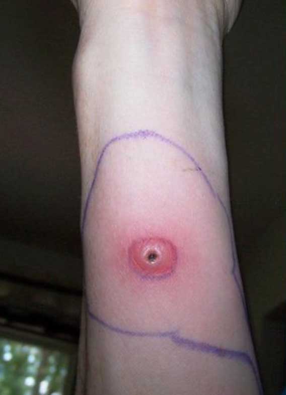 Ulcerated infected spider bite treatment