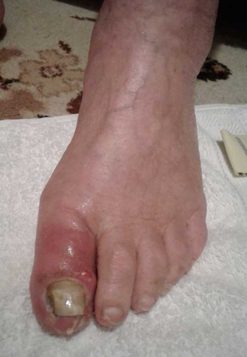 Infected toenail
