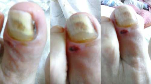 toenail days 467