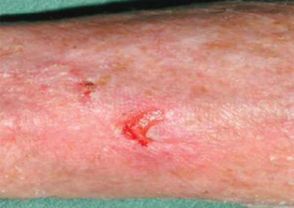 Category 2a Skin Tear