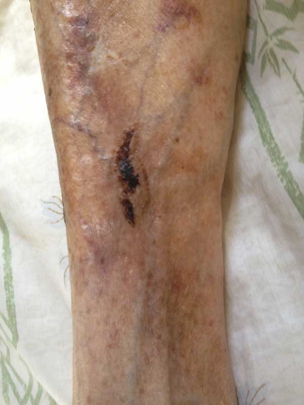 Large thin skin tear after 23 days treatment