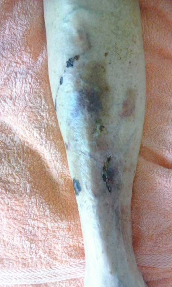 Large skin tear with thin bruised skin after treatment