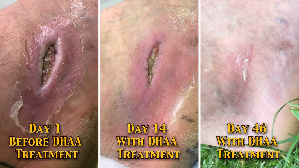 Ankle infection post surgery