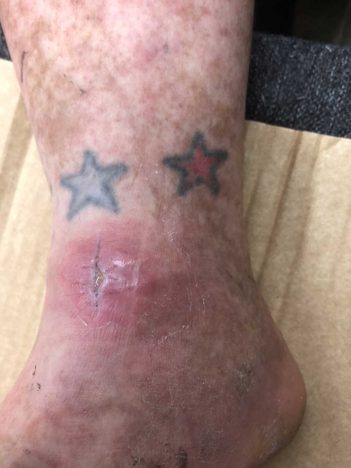 Ankle opposite infection