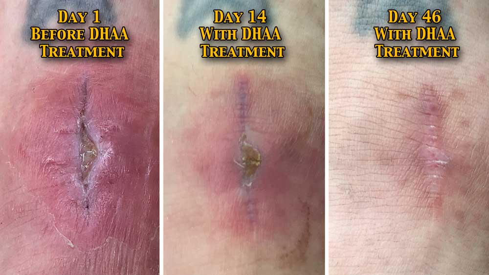 Shin infection post surgery