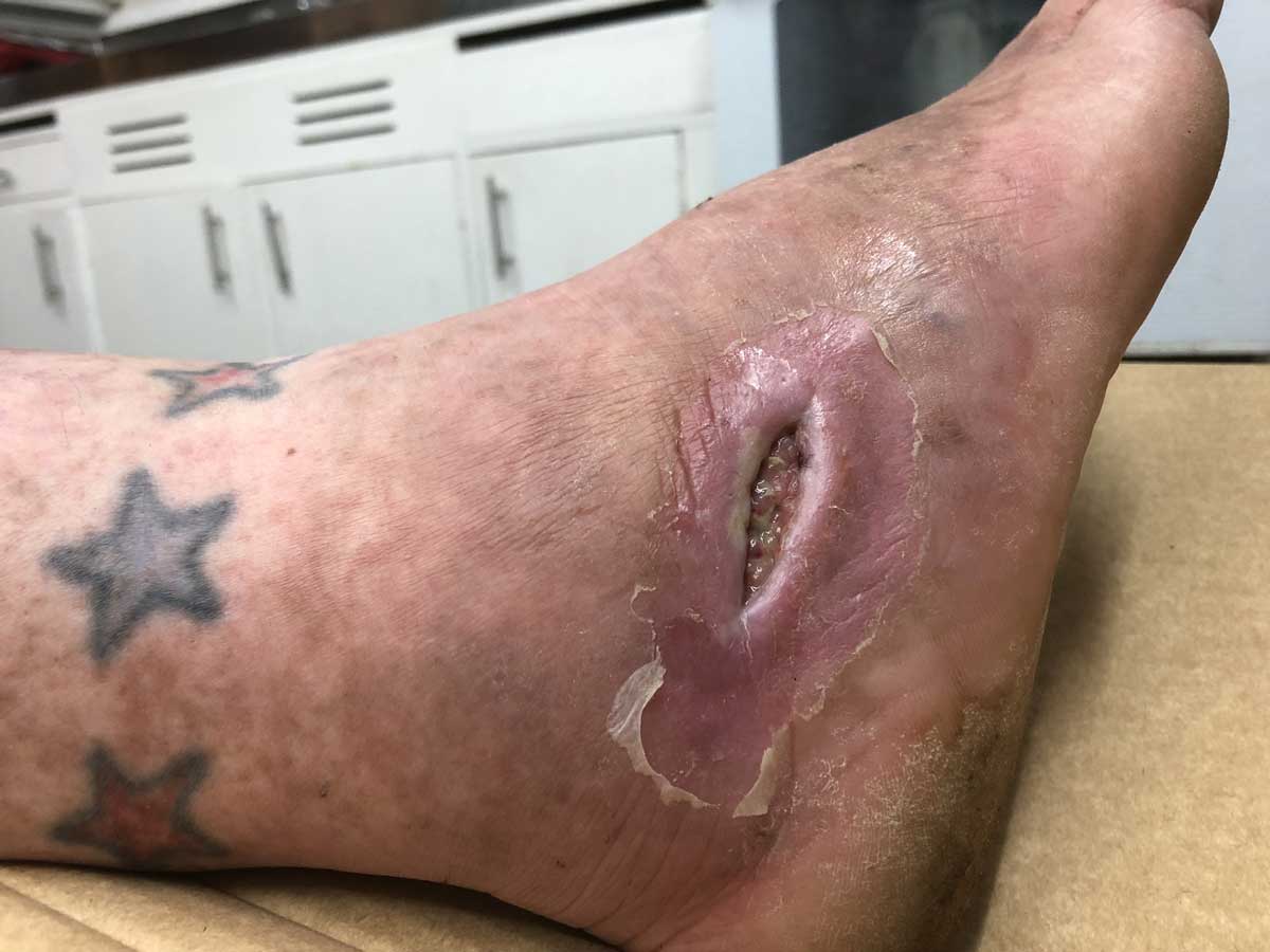 Ankle opposite infection