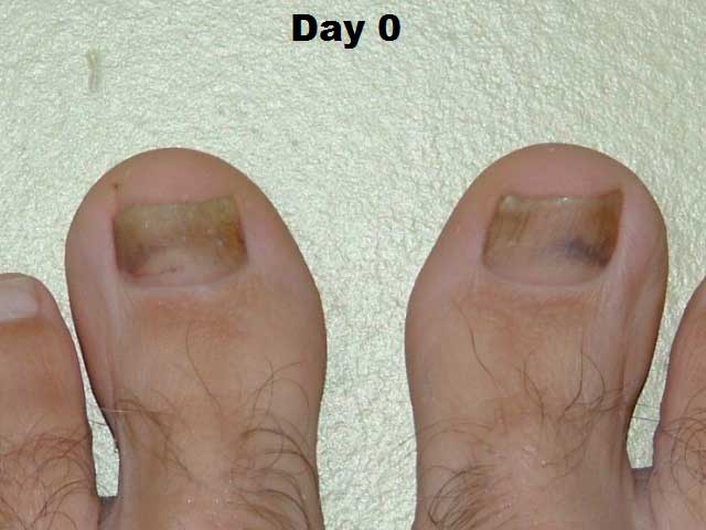 toenail fungus dhaa serum trial 1
